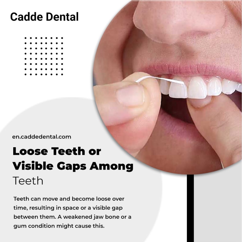 Loose Teeth or Visible Gaps Among Teeth