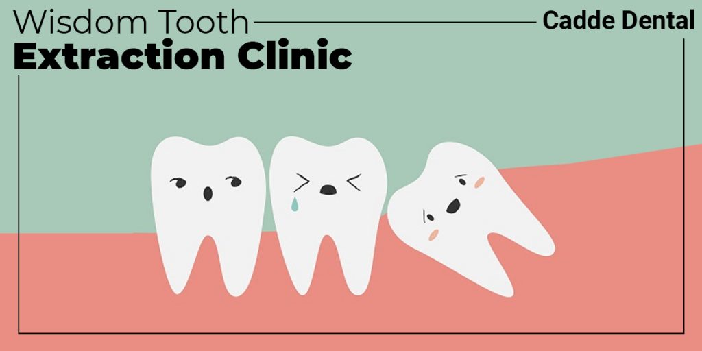 Wisdom tooth extraction clinic