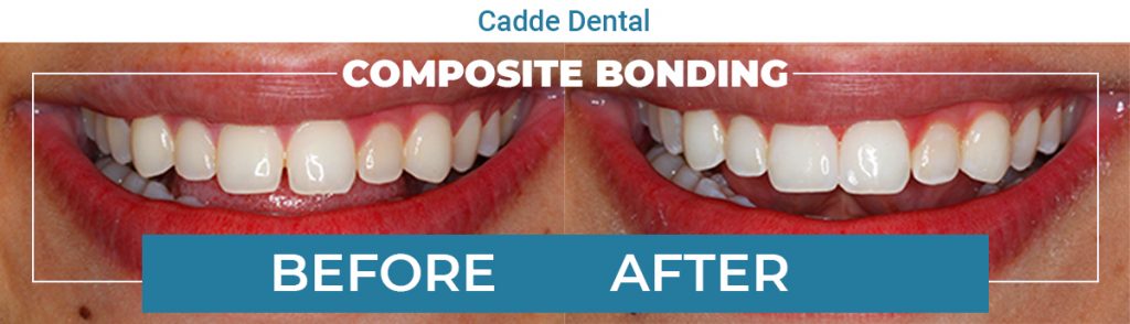 composite bonding before after