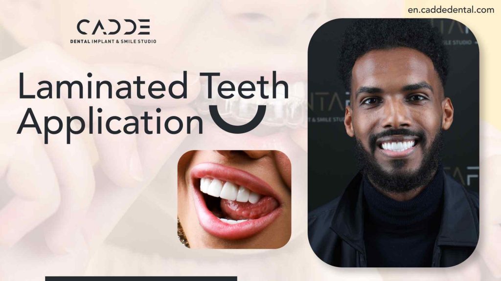 laminated teeth application