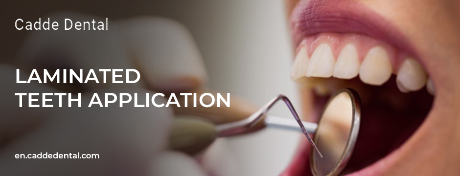 Laminated Teeth Application