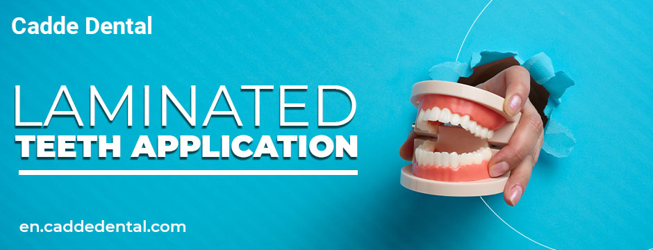 Laminated Teeth Application